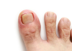 Toe still numb after ingrown toenail surgery